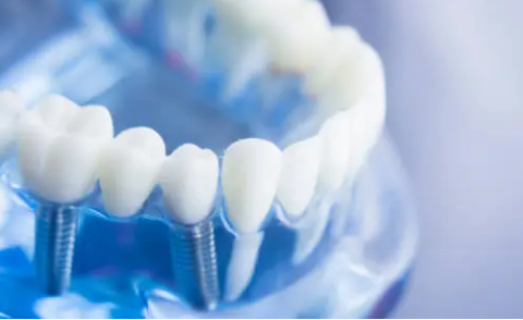 dental implants Adelaide
