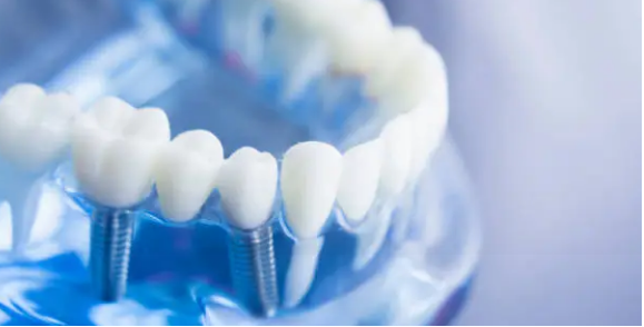 dental implants Adelaide